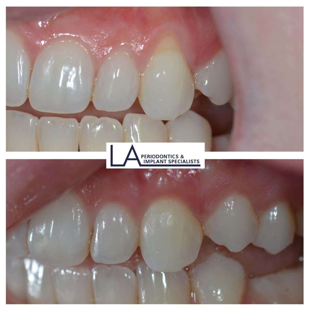 Before and after gum graft at LA Periodontics