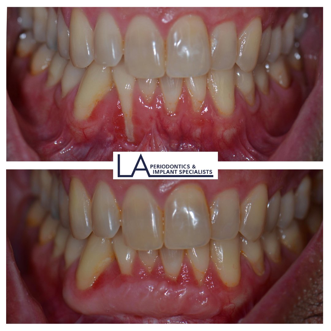 Before and after gum graft at LA Periodontics
