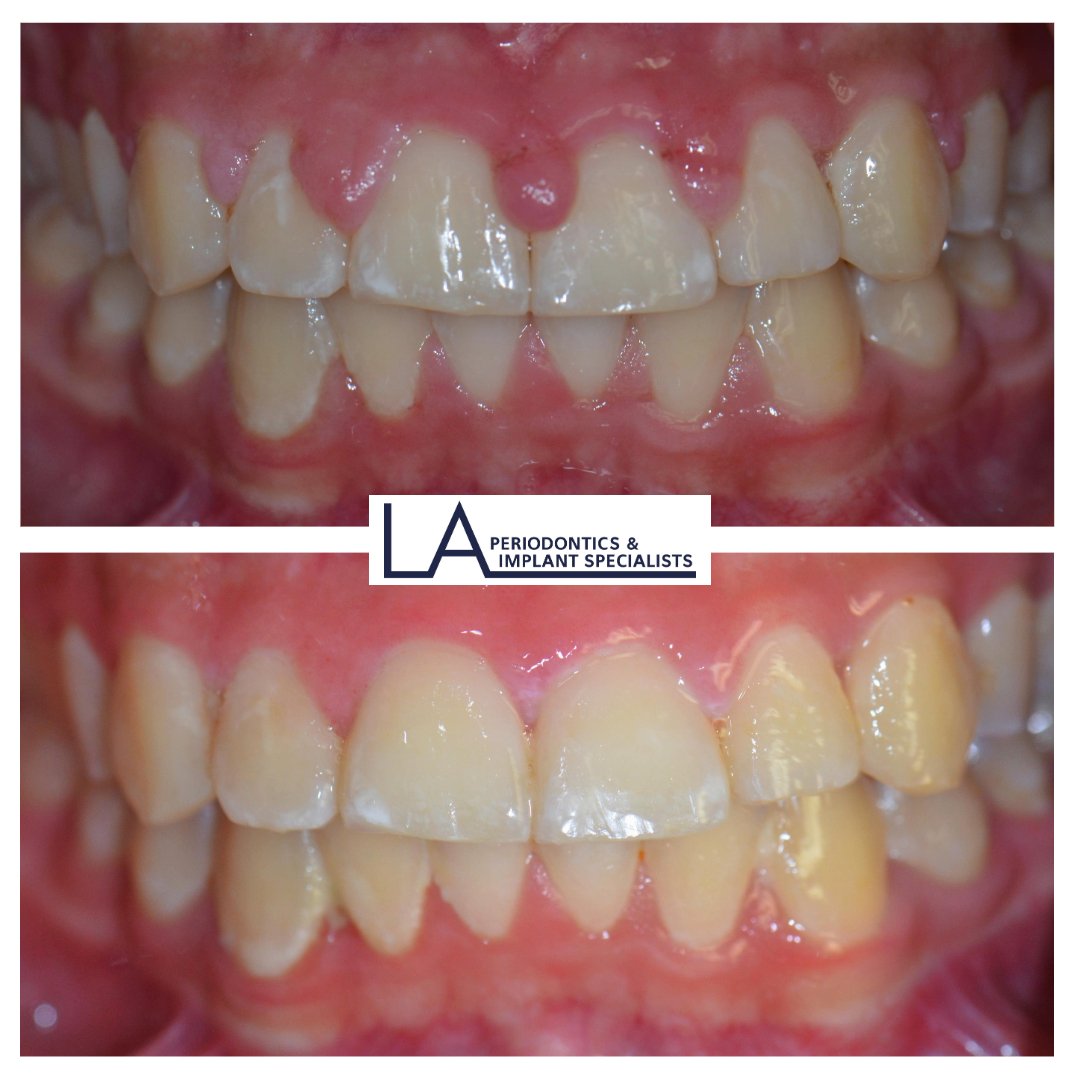 Before and after gummy smile treatment at LA Periodontics