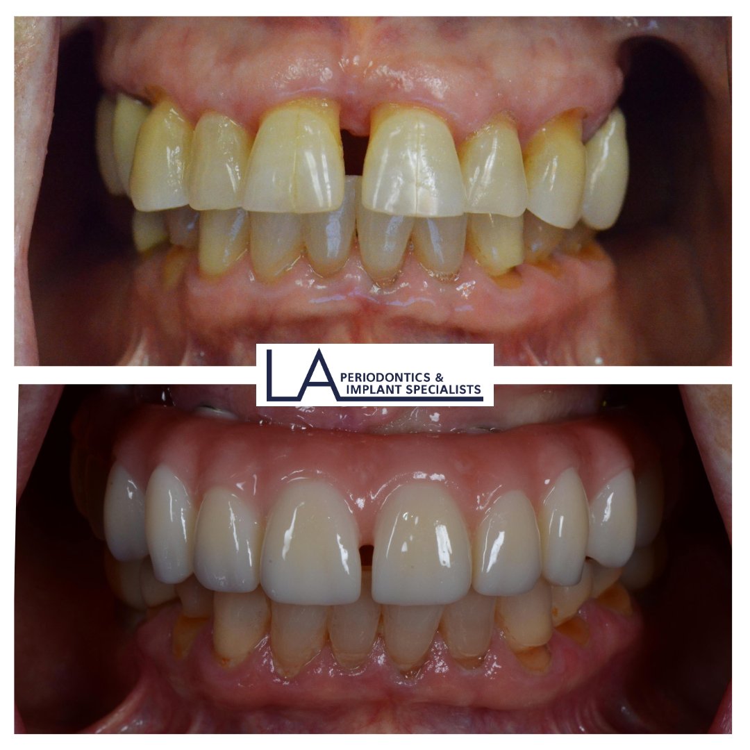 Before and after All-on-4 dental implants at LA Periodontics