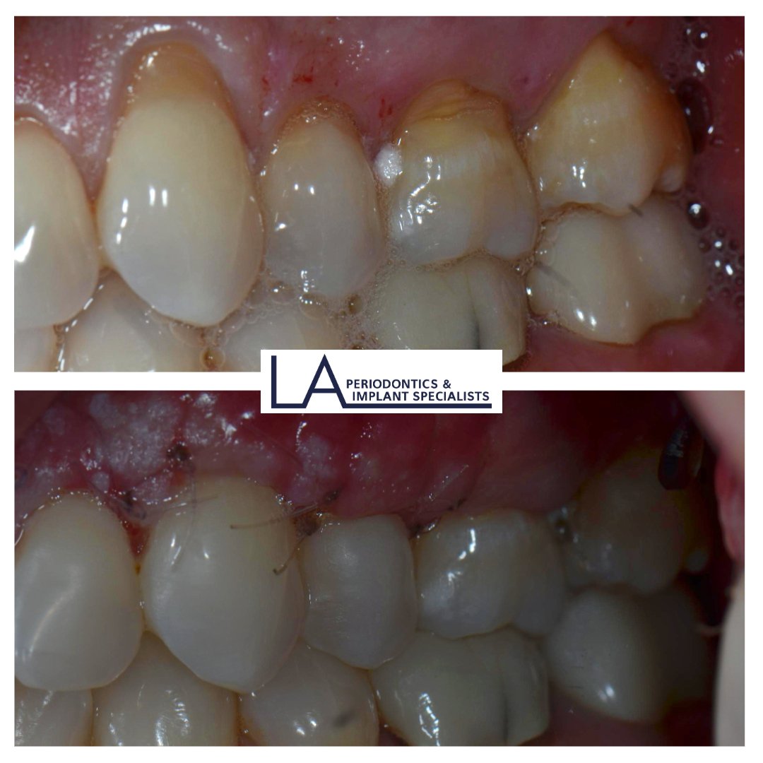 Before and after dental implant treatment at LA Periodontics