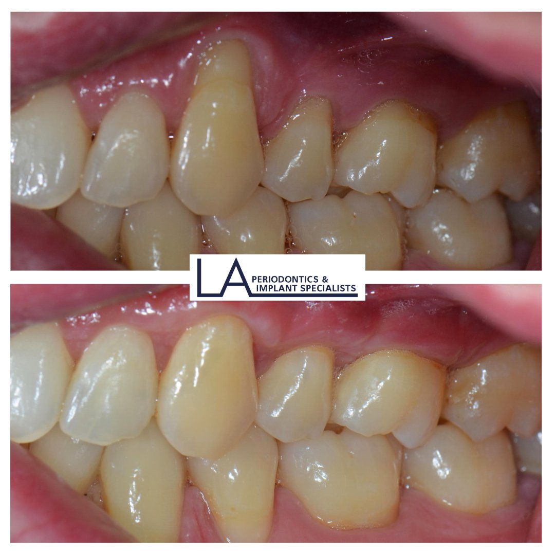 Before and after gum graft at LA Periodontics
