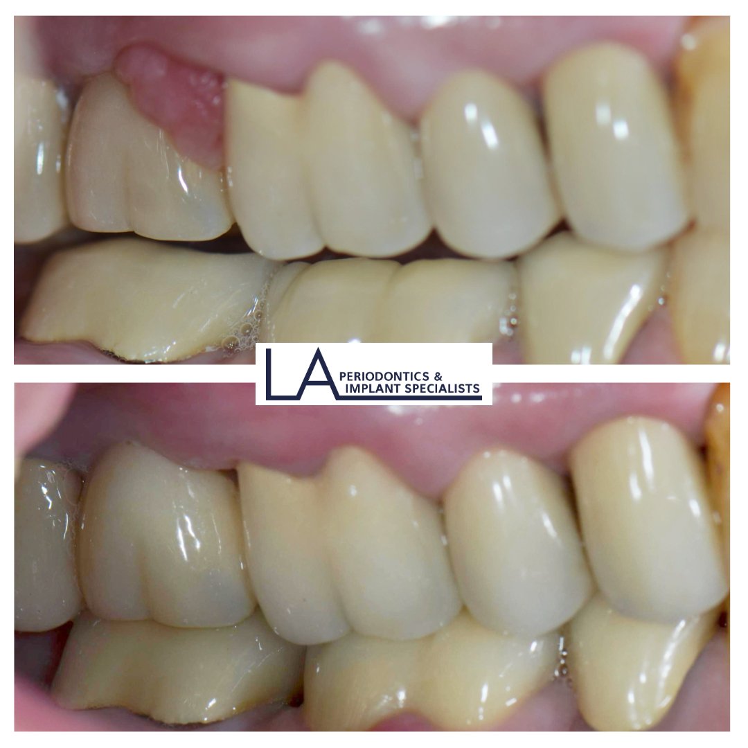 Before and after biopsy procedure at LA Periodontics