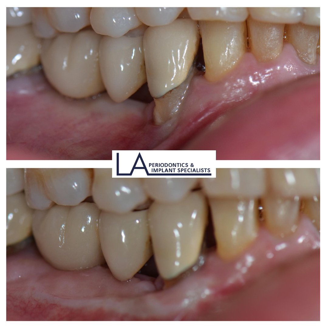 Before and after soft tissue graft at LA Periodontics