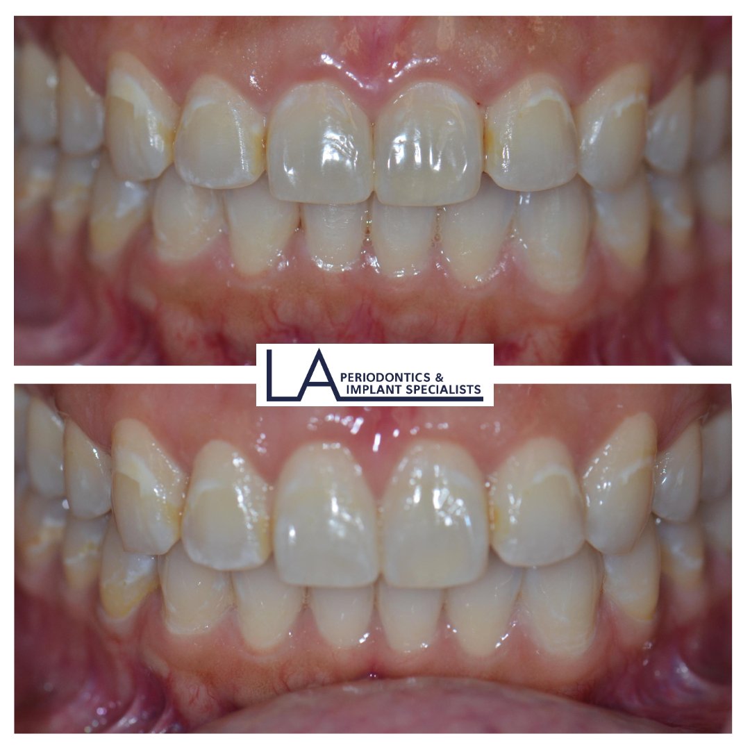 Before and after gummy smile treatment at LA Periodontics