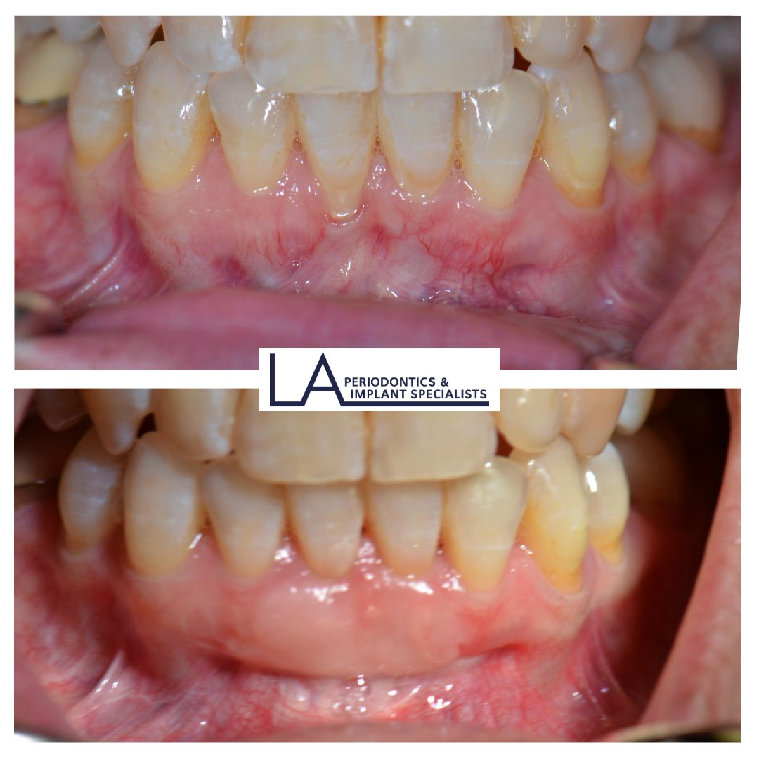 Before and after gum graft at LA Periodontics