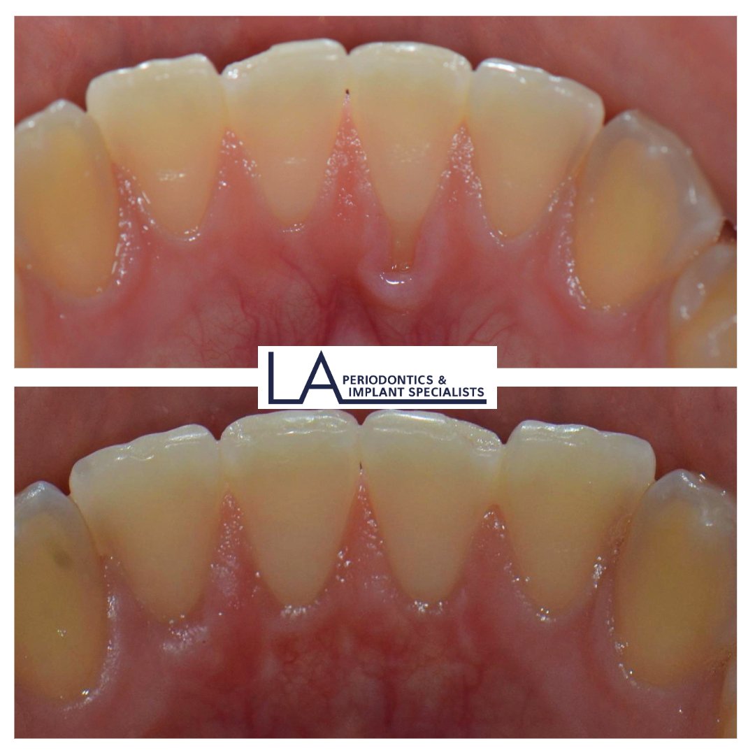 Before and after gum graft at LA Periodontics