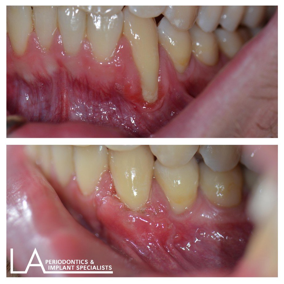 LA Periodontics patient before and after case 01, showing periodontal treatment result
