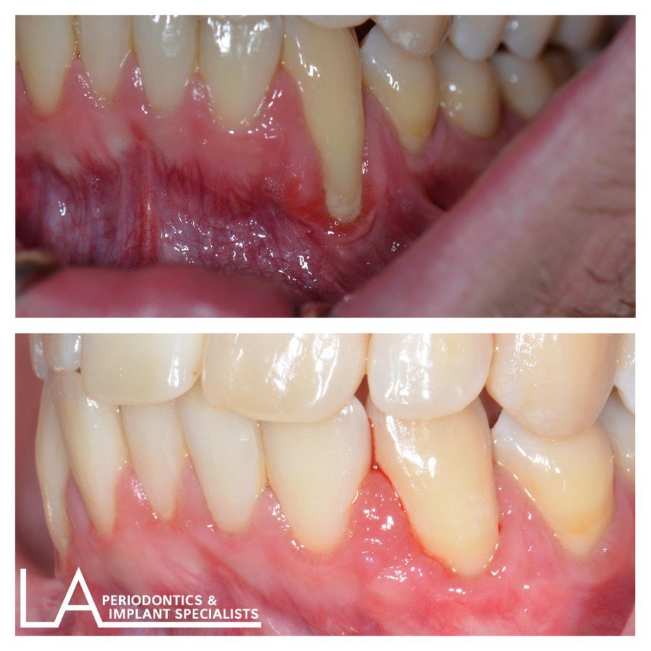 LA Periodontics patient before and after case 03, showing periodontal treatment result