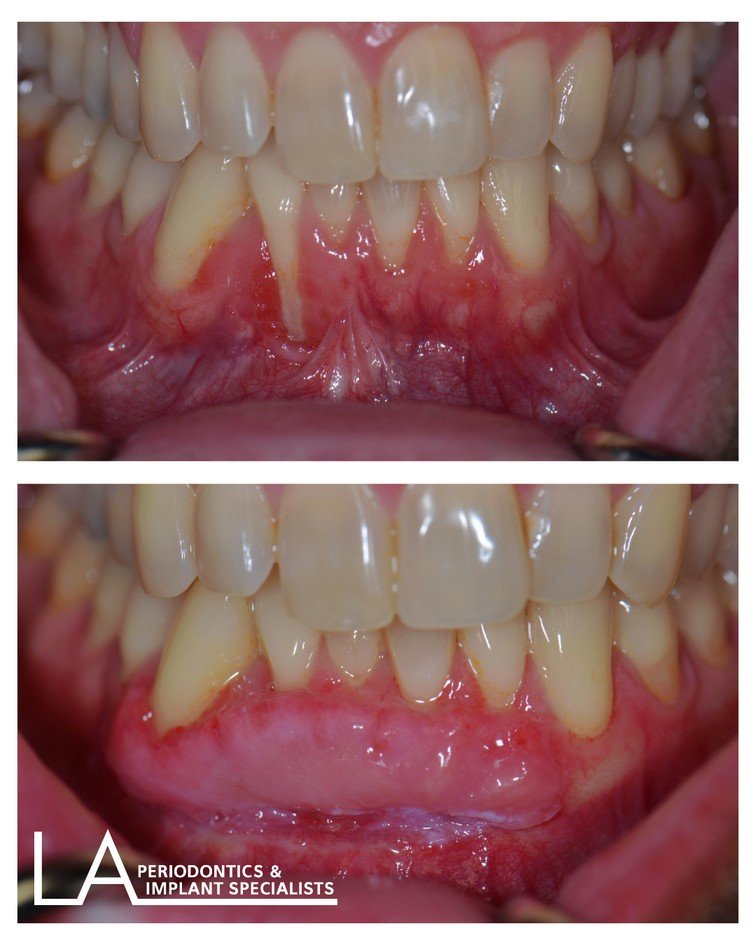 LA Periodontics patient before and after case 04, showing periodontal treatment result