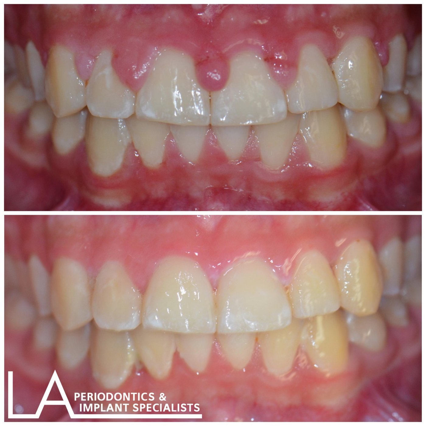 LA Periodontics patient before and after case 06, showing periodontal treatment result