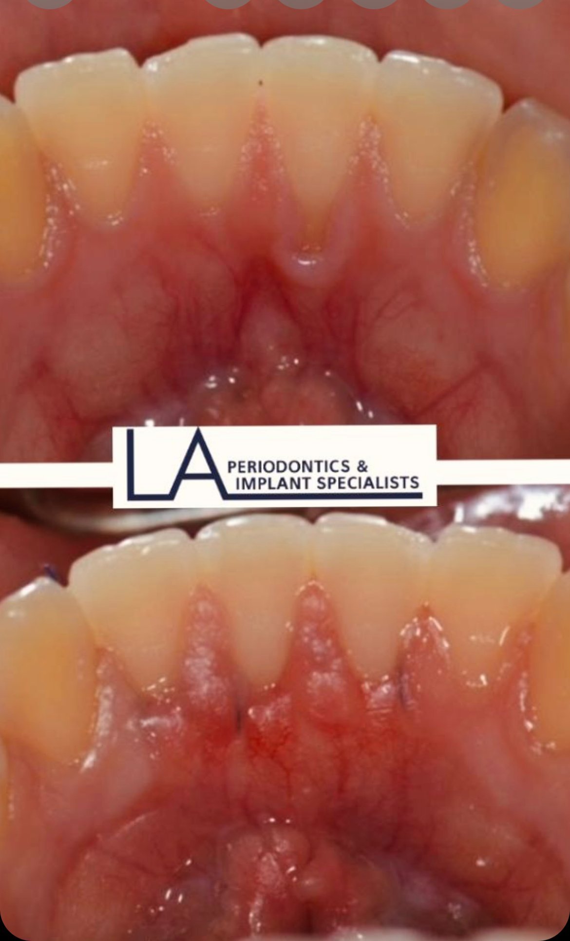 LA Periodontics patient before and after case 08, showing periodontal treatment result