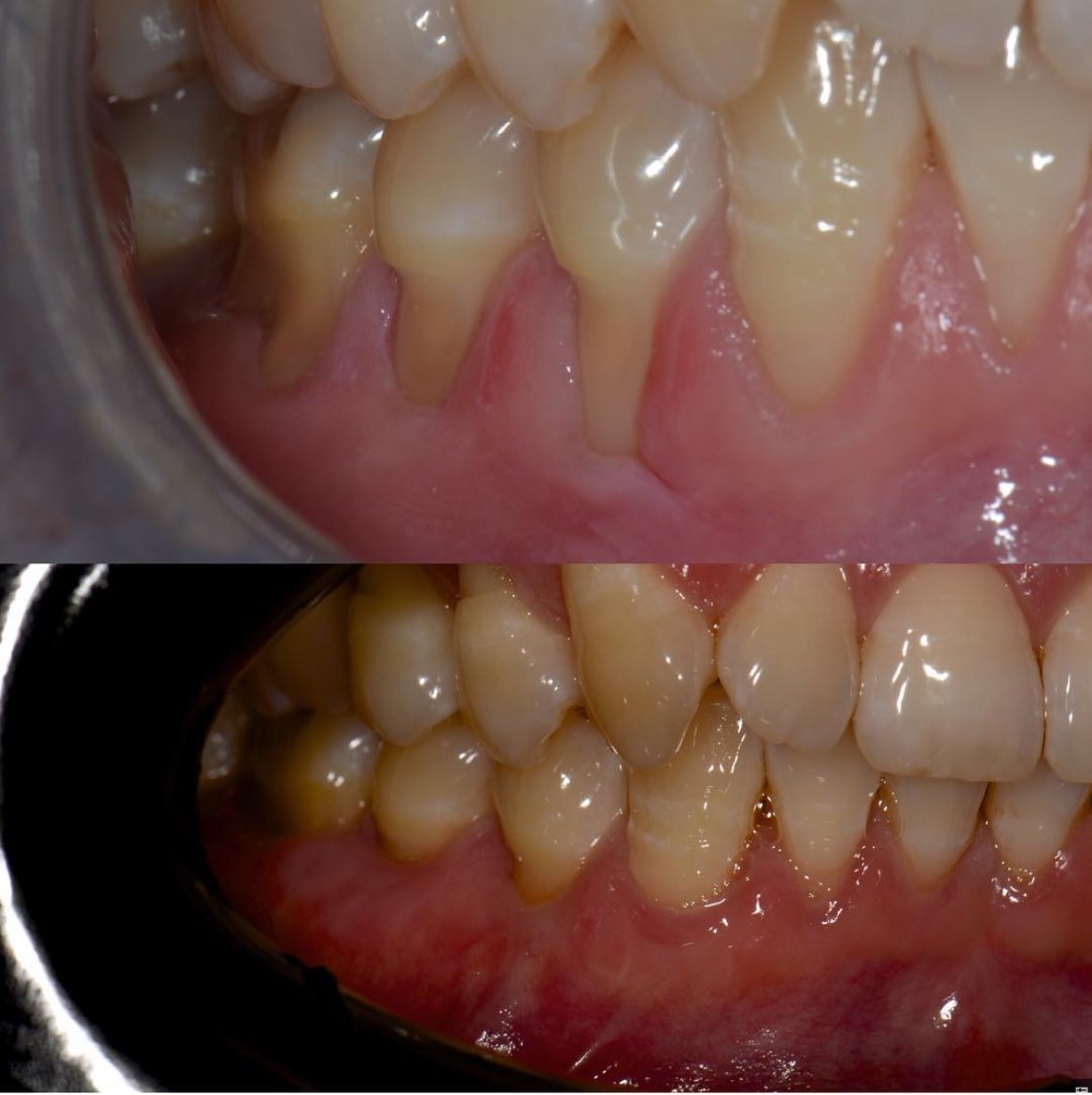 LA Periodontics patient before and after case 11, showing periodontal treatment result