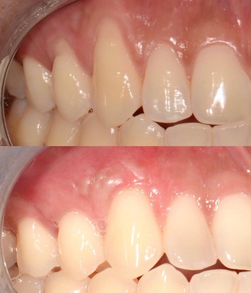 LA Periodontics patient before and after case 12, showing periodontal treatment result