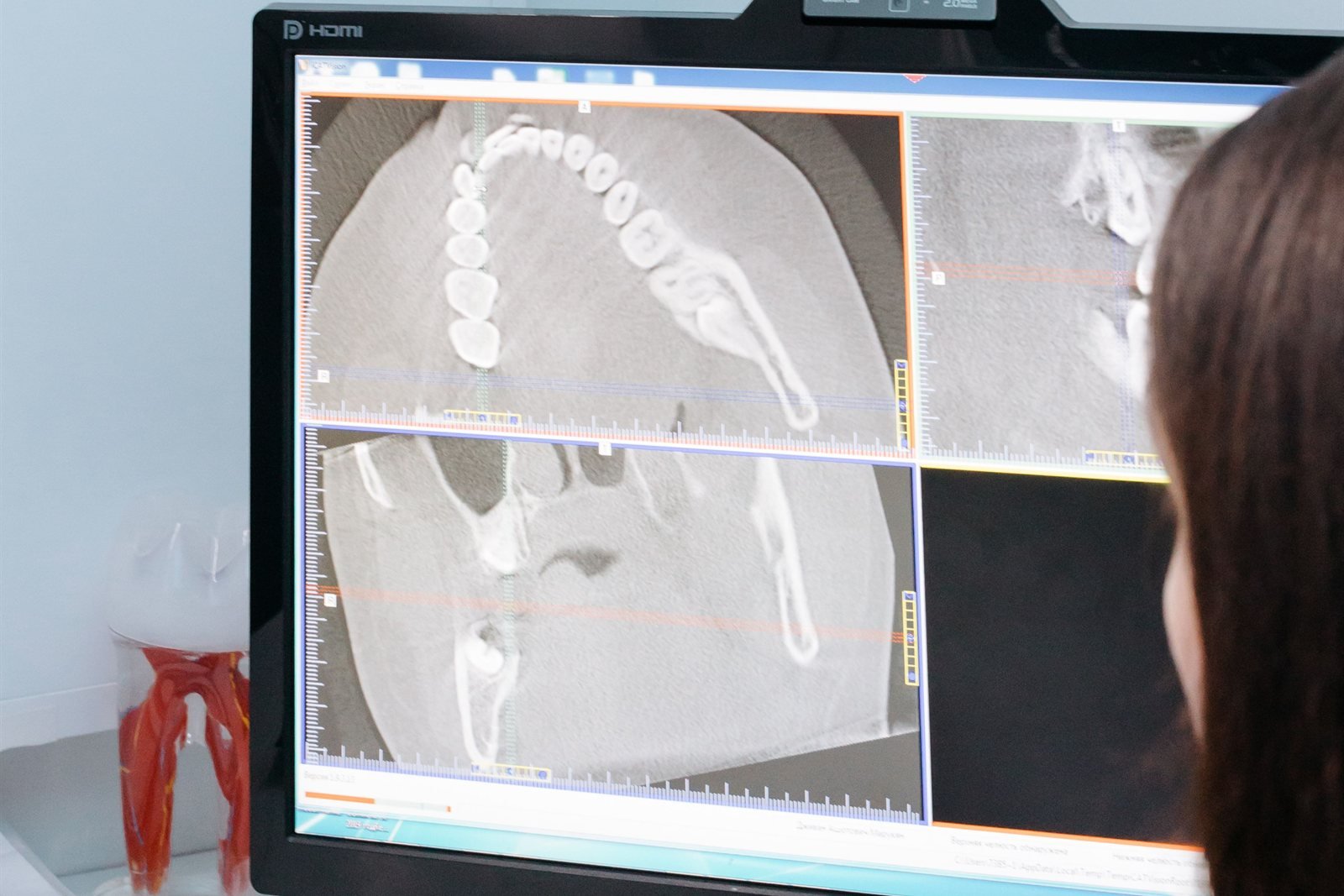Periodontist reviewing a 3D jawbone scan with a patient before bone graft treatment