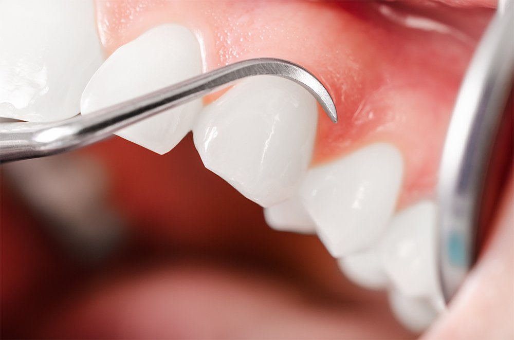 Periodontist examining a patient's gums for signs of periodontal disease in Los Angeles